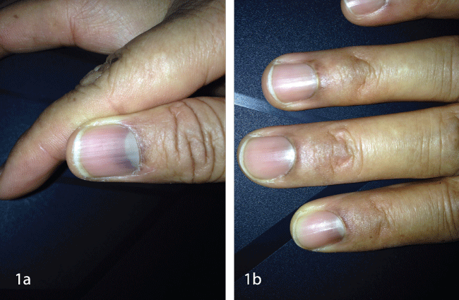 Blue Fingernails During Treatment With Cyclophosp