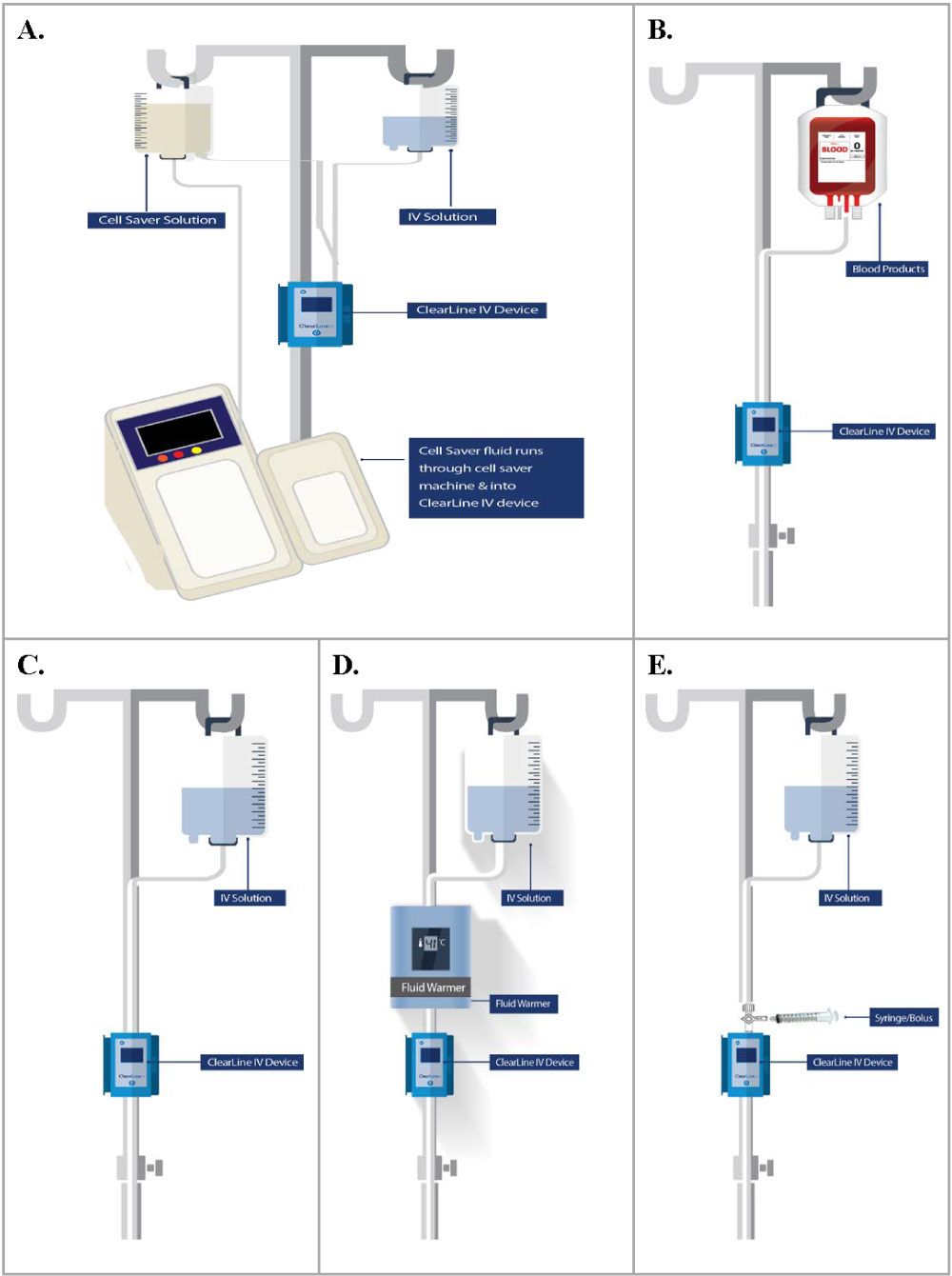 A Prospective Observational Study of Air Burden in Intravenous Tubing