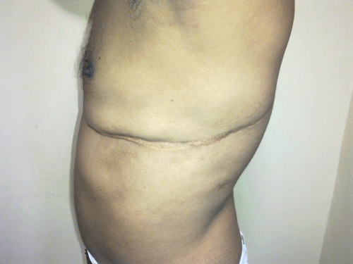 Figure 1: Postoperative scar mark (left lateral chest).