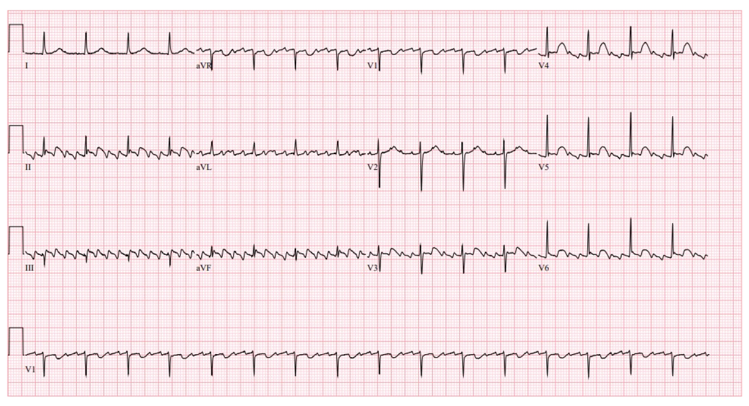 Figure 1: Initial EKG shows atrial flutter with 4:1 conduction and a ...
