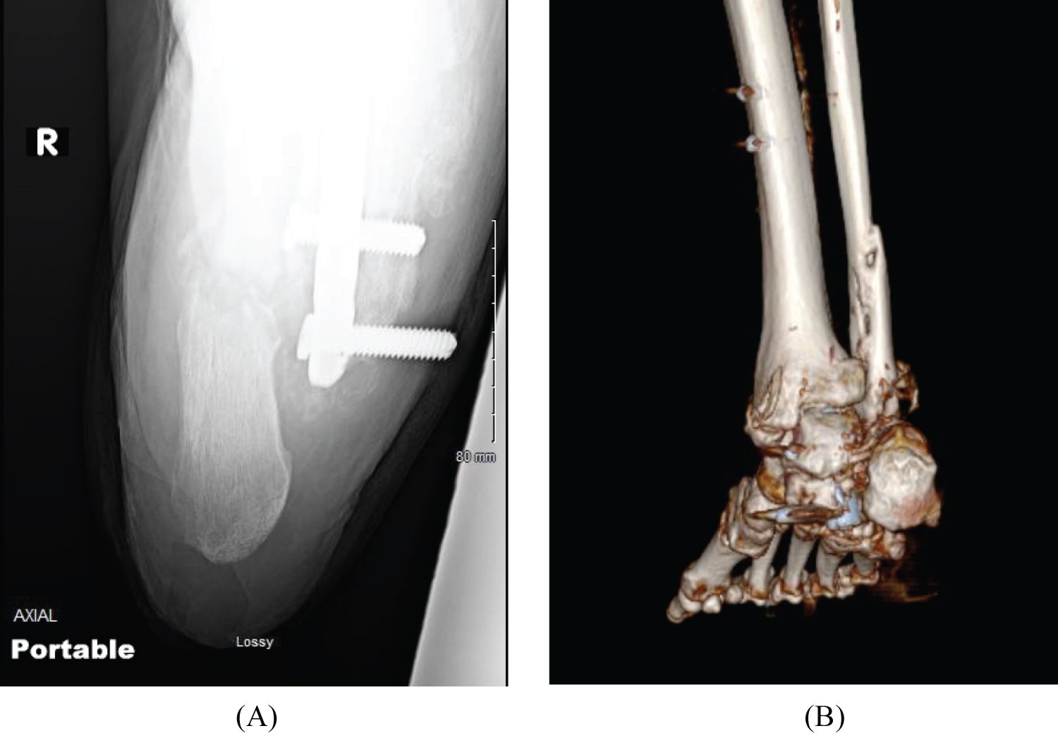 Catastrophic Hindfoot Collapse after Tibiotalocalcaneal Nailing: A Case  Series