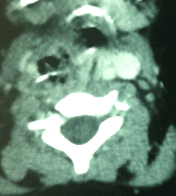 Figure 1: CT axial image of neck showing the metallic foreign body.