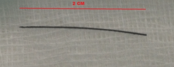 Figure 2: CT sagittal image of neck showing the metallic foreign body.