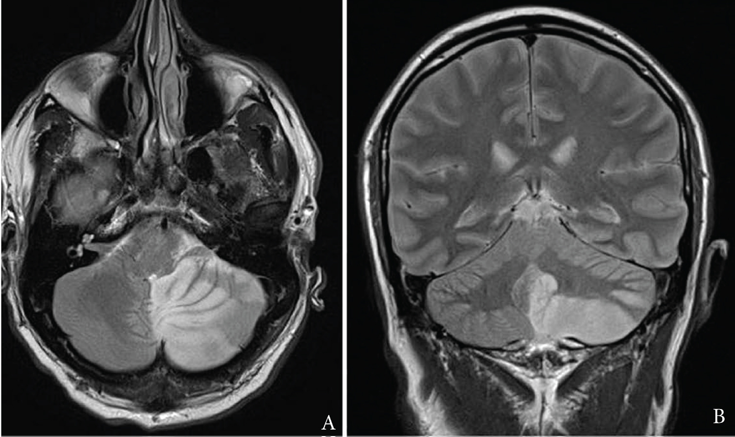 Outcomes Following Suboccipital Decompressive Craniectomy For Posterior Outcomes Following Suboccipital Decompressive Craniectomy For Posterior