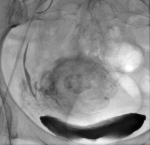 Figure 1: Stagnation of contrast medium in the uterus after chemoembolization
confirms the effectiveness of the procedure.