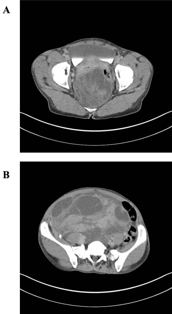 Figure 1: Preoperative CT imaging of abdomen and pelvis demonstrating
large pelvic mass consistent with enlarging uterine fibroids.