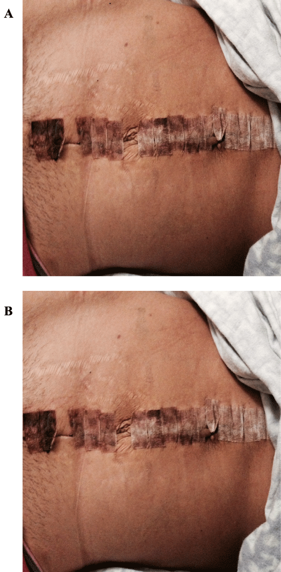 Figure 2: Photograph of patients abdomen on postoperative day #5 at the
time crepitus was appreciated on physical exam. Overall, her abdominal
exam was found to be normal except for crepitus. There was no evidence
of erythema, induration, wound discharge, distension, or other abnormal
physical findings.