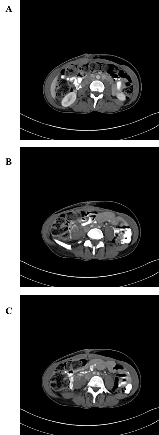 Figure 3: CT imaging of abdomen and pelvis on postoperative day #5
demonstrating massive subcutaneous emphysema.