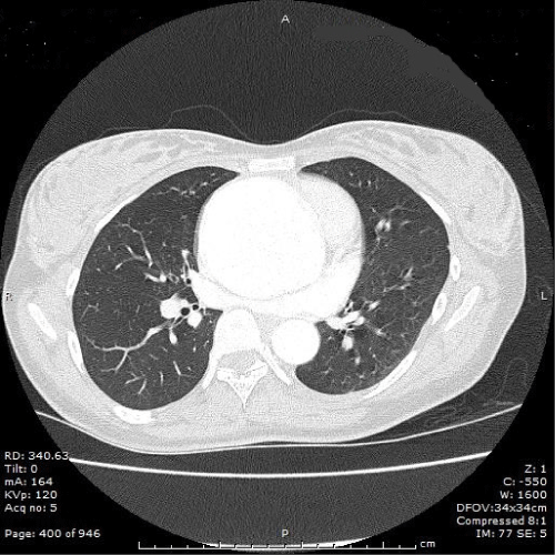 Figure 1: Computed tomography angiogram chest/abdomen/pelvis with
contrast at 16 weeks gestation. Fusiform aneurysm from the aortic root
to the distal ascending aorta, maximum 7.3cm in the mid ascending. No
evidence of dissection.