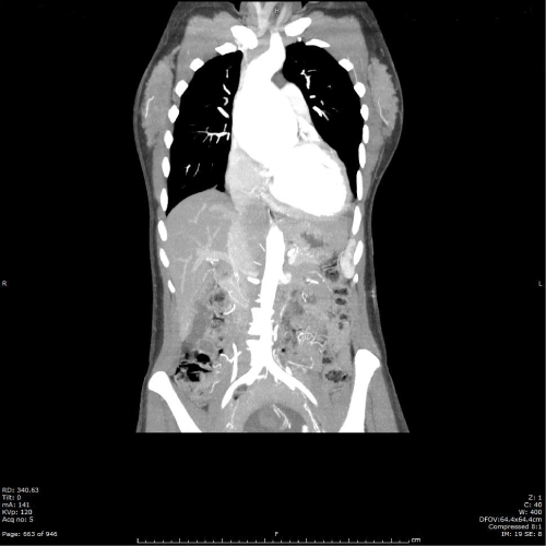 Figure 2: Computed tomography angiogram chest/abdomen/pelvis with
contrast at 16 weeks gestation. Enlarged left ventricle suggesting volume
overload aortic regurgitation.