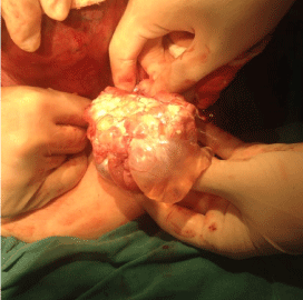 Figure 1: Exploration in the surgery revealed a 70x60x80mm mass with cystic
and solid components on the right ovary.