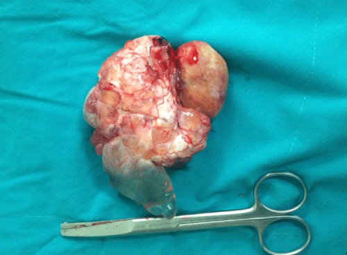 Figure 2: The appearance of the mass as an impression of a malignant
neoplasm.
