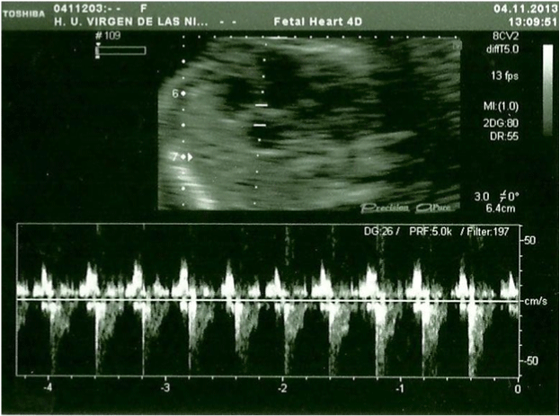 Figure 3: Fetal heart ultrasound in the 20th week, Tricuspid regurgitation.