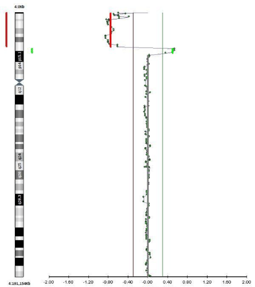 Figure 5: A karyotype 46 XX, Addition on the short arm of chromosome 4
with an atypical pattern of bands that could not be determined A karyotype
46 XX, Addition on the short arm of chromosome 4 with an atypical pattern
of bands that could not be determined.