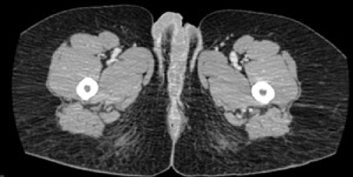 Figure 1: CAT scan of the abdomen and pelvis of patient #2, thickening of
right vulva.