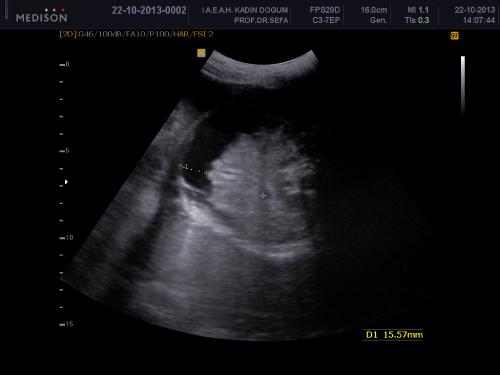 Figure 2: Computed tomography angiogram chest/abdomen/pelvis with
contrast at 16 weeks gestation. Enlarged left ventricle suggesting volume
overload aortic regurgitation.