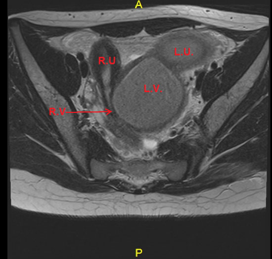 Herlyn-Werner-Wunderlich Syndrome: A Rare Cause of Acute Abdomen in ...