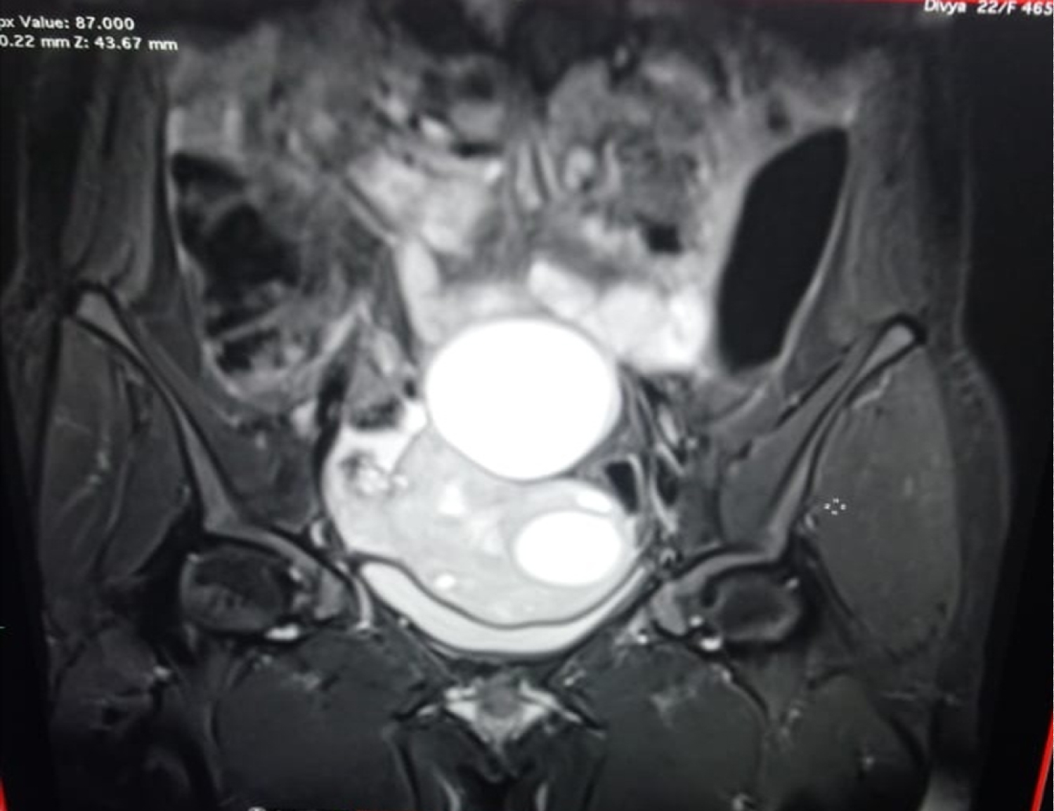 Hemorrhagic Cyst Mri