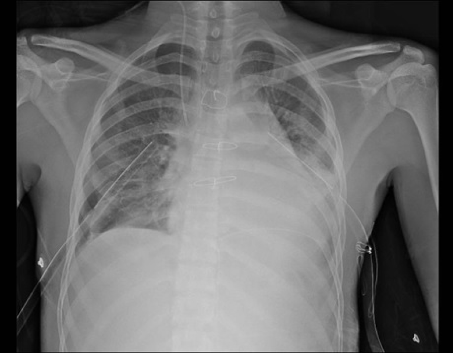 Successful Management Of Penetrating Cardiac Injury Case Report Successful Management Of Penetrating Cardiac Injury Case Report